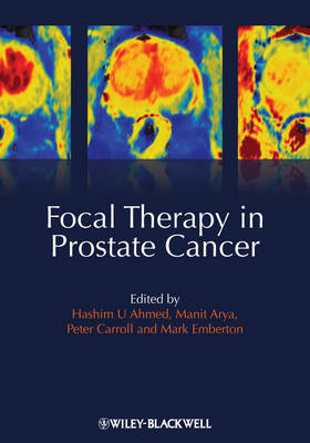 Focal Therapy in Prostate Cancer