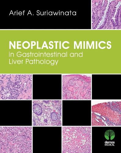 Neoplastic Mimics in Gastrointestinal and Liver Pathology